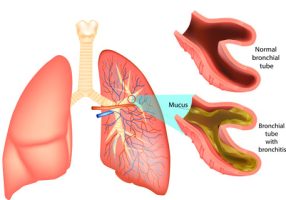 Halotherapie helpt bij het zuiveren van de longen bij bronchitis